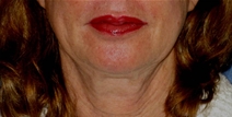 Facelift Before Photo by Neal Goldberg, MD; Scarsdale, NY - Case 22690