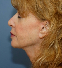 Facelift After Photo by Neal Goldberg, MD; Scarsdale, NY - Case 22690
