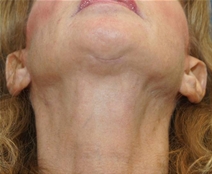 Facelift After Photo by Neal Goldberg, MD; Scarsdale, NY - Case 22690