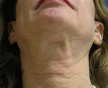 Facelift Before Photo by Neal Goldberg, MD; Scarsdale, NY - Case 22690