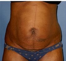 Tummy Tuck Before Photo by Neal Goldberg, MD; Scarsdale, NY - Case 22978