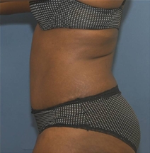 Tummy Tuck After Photo by Neal Goldberg, MD; Scarsdale, NY - Case 22978