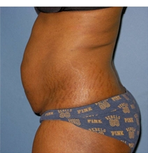 Tummy Tuck Before Photo by Neal Goldberg, MD; Scarsdale, NY - Case 22978
