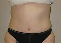 Tummy Tuck After Photo by Neal Goldberg, MD; Scarsdale, NY - Case 22980