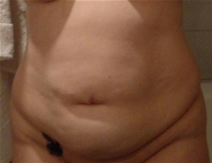 Tummy Tuck Before Photo by Neal Goldberg, MD; Scarsdale, NY - Case 22980