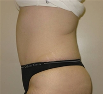 Tummy Tuck After Photo by Neal Goldberg, MD; Scarsdale, NY - Case 22980