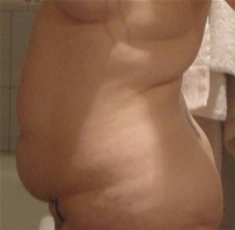Tummy Tuck Before Photo by Neal Goldberg, MD; Scarsdale, NY - Case 22980