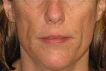 Dermal Fillers Before Photo by Neal Goldberg, MD; Scarsdale, NY - Case 23036