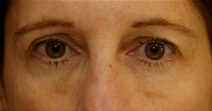 Dermal Fillers After Photo by Neal Goldberg, MD; Scarsdale, NY - Case 23036