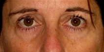 Dermal Fillers Before Photo by Neal Goldberg, MD; Scarsdale, NY - Case 23036