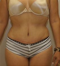 Tummy Tuck After Photo by Neal Goldberg, MD; Scarsdale, NY - Case 23037