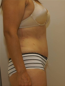 Tummy Tuck After Photo by Neal Goldberg, MD; Scarsdale, NY - Case 23037