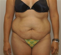 Tummy Tuck Before Photo by Neal Goldberg, MD; Scarsdale, NY - Case 23037