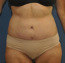 Tummy Tuck After Photo by Neal Goldberg, MD; Scarsdale, NY - Case 23042