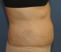 Tummy Tuck After Photo by Neal Goldberg, MD; Scarsdale, NY - Case 23042