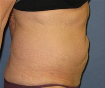 Tummy Tuck Before Photo by Neal Goldberg, MD; Scarsdale, NY - Case 23042