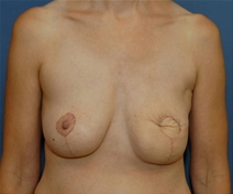 Breast Reconstruction After Photo by Neal Goldberg, MD; Scarsdale, NY - Case 23044