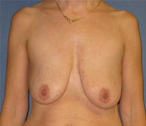 Breast Reconstruction Before Photo by Neal Goldberg, MD; Scarsdale, NY - Case 23044
