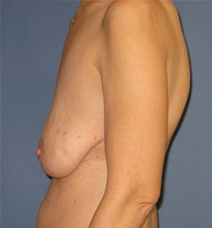 Breast Reconstruction Before Photo by Neal Goldberg, MD; Scarsdale, NY - Case 23044