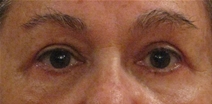 Eyelid Surgery After Photo by Neal Goldberg, MD; Scarsdale, NY - Case 23126