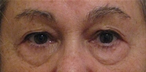 Eyelid Surgery Before Photo by Neal Goldberg, MD; Scarsdale, NY - Case 23126
