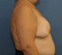 Breast Reconstruction After Photo by Neal Goldberg, MD; Scarsdale, NY - Case 23150