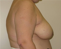 Breast Reconstruction Before Photo by Neal Goldberg, MD; Scarsdale, NY - Case 23150
