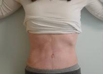 Tummy Tuck After Photo by Neal Goldberg, MD; Scarsdale, NY - Case 7745