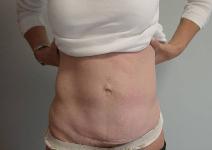 Tummy Tuck Before Photo by Neal Goldberg, MD; Scarsdale, NY - Case 7745