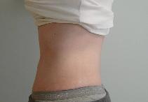 Tummy Tuck After Photo by Neal Goldberg, MD; Scarsdale, NY - Case 7745