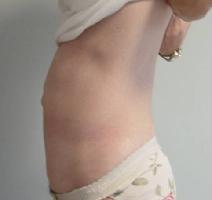 Tummy Tuck Before Photo by Neal Goldberg, MD; Scarsdale, NY - Case 7745