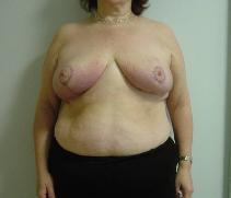 Breast Reduction After Photo by Neal Goldberg, MD; Scarsdale, NY - Case 7746
