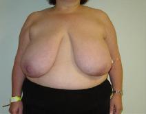 Breast Reduction Before Photo by Neal Goldberg, MD; Scarsdale, NY - Case 7746