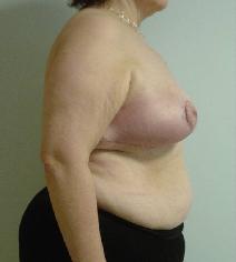 Breast Reduction After Photo by Neal Goldberg, MD; Scarsdale, NY - Case 7746