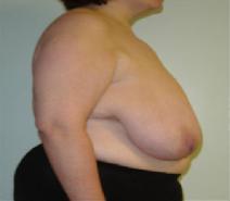 Breast Reduction Before Photo by Neal Goldberg, MD; Scarsdale, NY - Case 7746