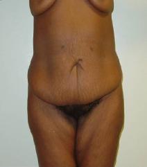Body Contouring Before Photo by Neal Goldberg, MD; Scarsdale, NY - Case 7748