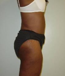 Body Contouring After Photo by Neal Goldberg, MD; Scarsdale, NY - Case 7748