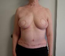 Breast Reconstruction After Photo by Neal Goldberg, MD; Scarsdale, NY - Case 7749