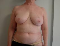 Breast Reconstruction Before Photo by Neal Goldberg, MD; Scarsdale, NY - Case 7749