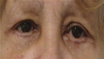 Eyelid Surgery After Photo by Neal Goldberg, MD; Scarsdale, NY - Case 7751