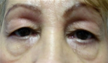Eyelid Surgery Before Photo by Neal Goldberg, MD; Scarsdale, NY - Case 7751