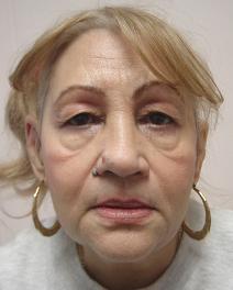 Facelift Before Photo by Neal Goldberg, MD; Scarsdale, NY - Case 7752