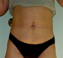 Liposuction After Photo by Neal Goldberg, MD; Scarsdale, NY - Case 7759