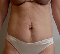Liposuction Before Photo by Neal Goldberg, MD; Scarsdale, NY - Case 7759