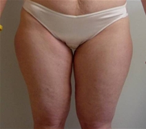 Liposuction Before Photo by Neal Goldberg, MD; Scarsdale, NY - Case 7759