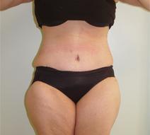 Body Contouring After Photo by Neal Goldberg, MD; Scarsdale, NY - Case 7988
