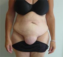 Body Contouring Before Photo by Neal Goldberg, MD; Scarsdale, NY - Case 7988