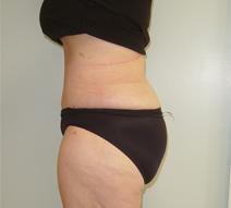 Body Contouring After Photo by Neal Goldberg, MD; Scarsdale, NY - Case 7988