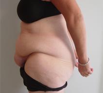 Body Contouring Before Photo by Neal Goldberg, MD; Scarsdale, NY - Case 7988
