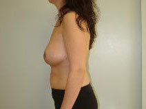 Breast Reduction After Photo by Neal Goldberg, MD; Scarsdale, NY - Case 8171